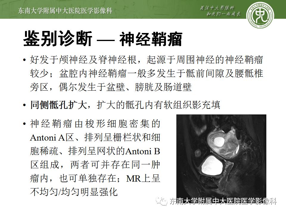 【病例】盆部侵袭性血管粘液瘤1例CT及MR影像诊断