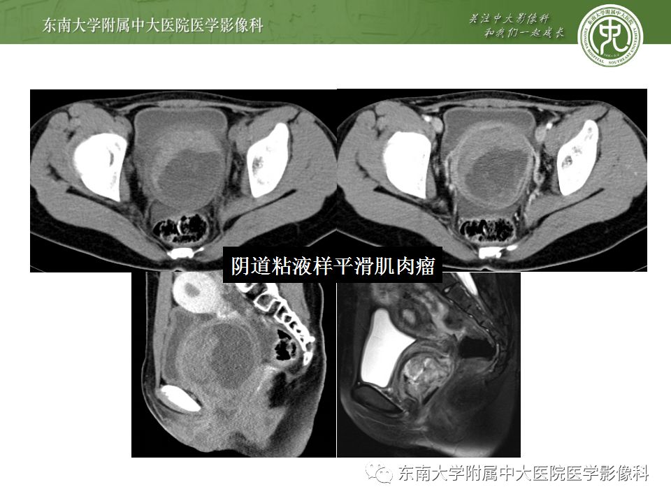 【病例】盆部侵袭性血管粘液瘤1例CT及MR影像诊断