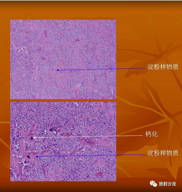 【病例】步步深入——韩志江老师手把手教你学甲状腺！