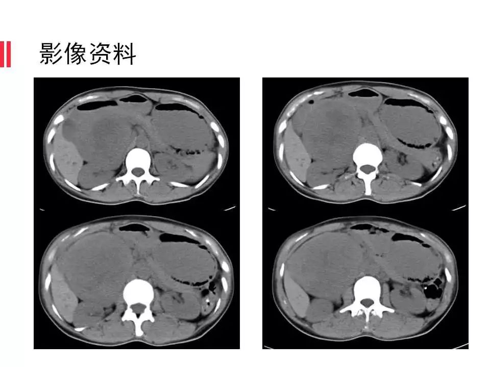【病例】腹膜后间质瘤1例CT影像表现
