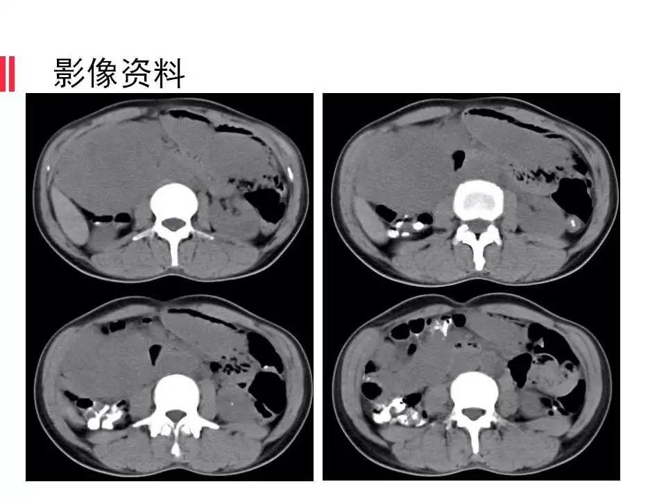 【病例】腹膜后间质瘤1例CT影像表现