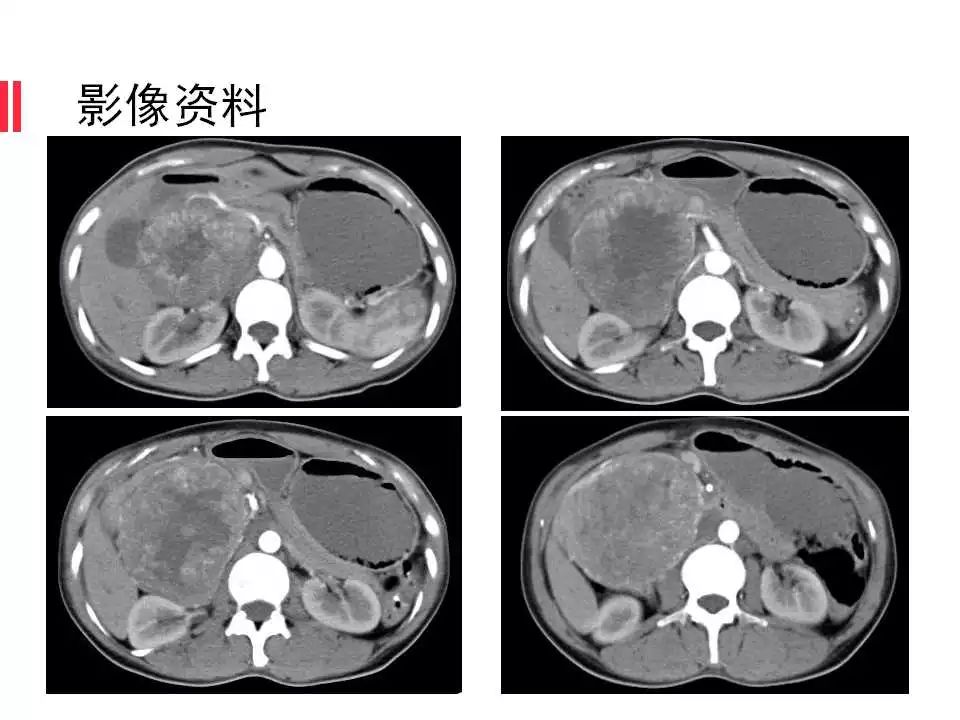 【病例】腹膜后间质瘤1例CT影像表现