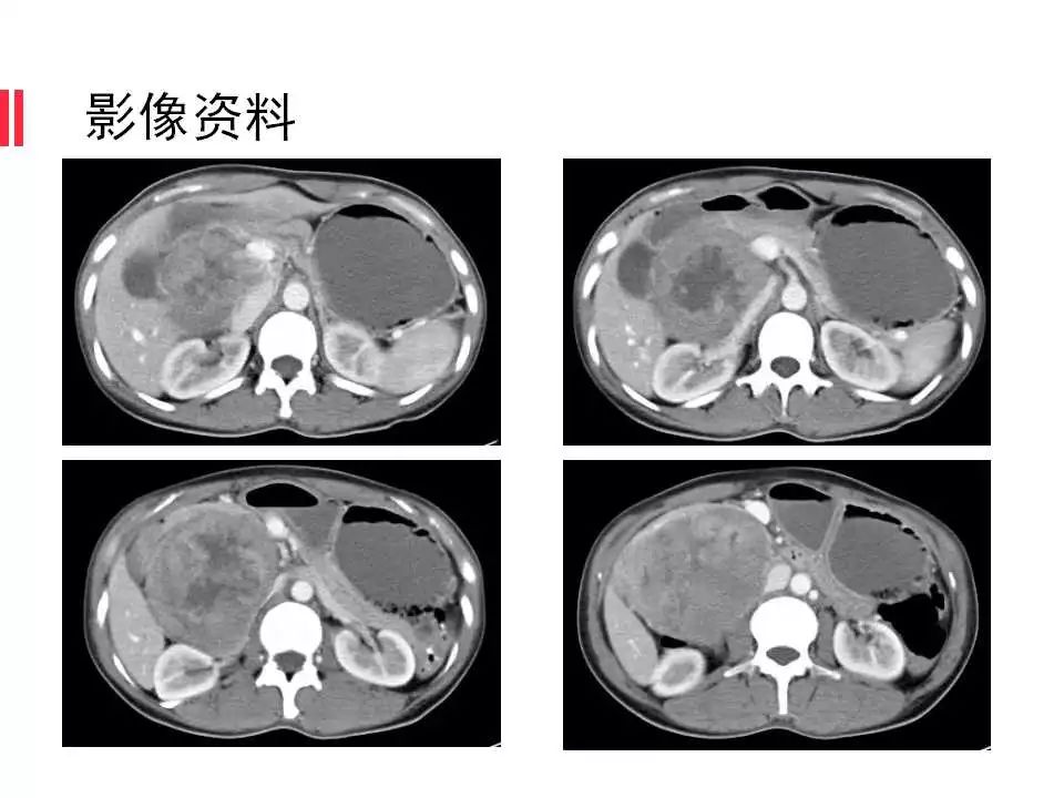 【病例】腹膜后间质瘤1例CT影像表现