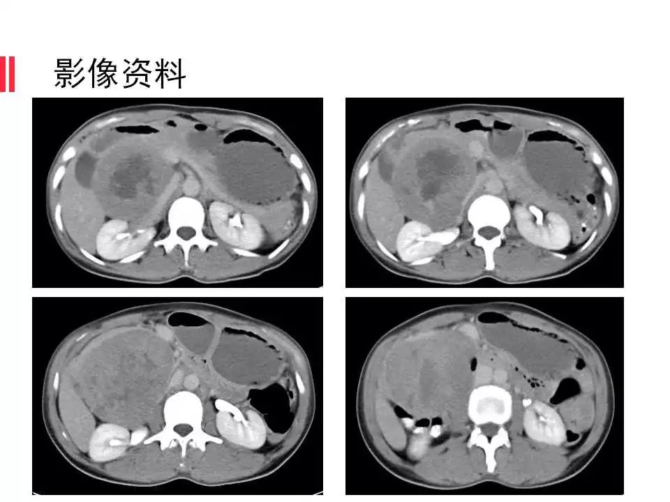 【病例】腹膜后间质瘤1例CT影像表现