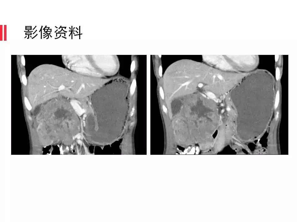 【病例】腹膜后间质瘤1例CT影像表现