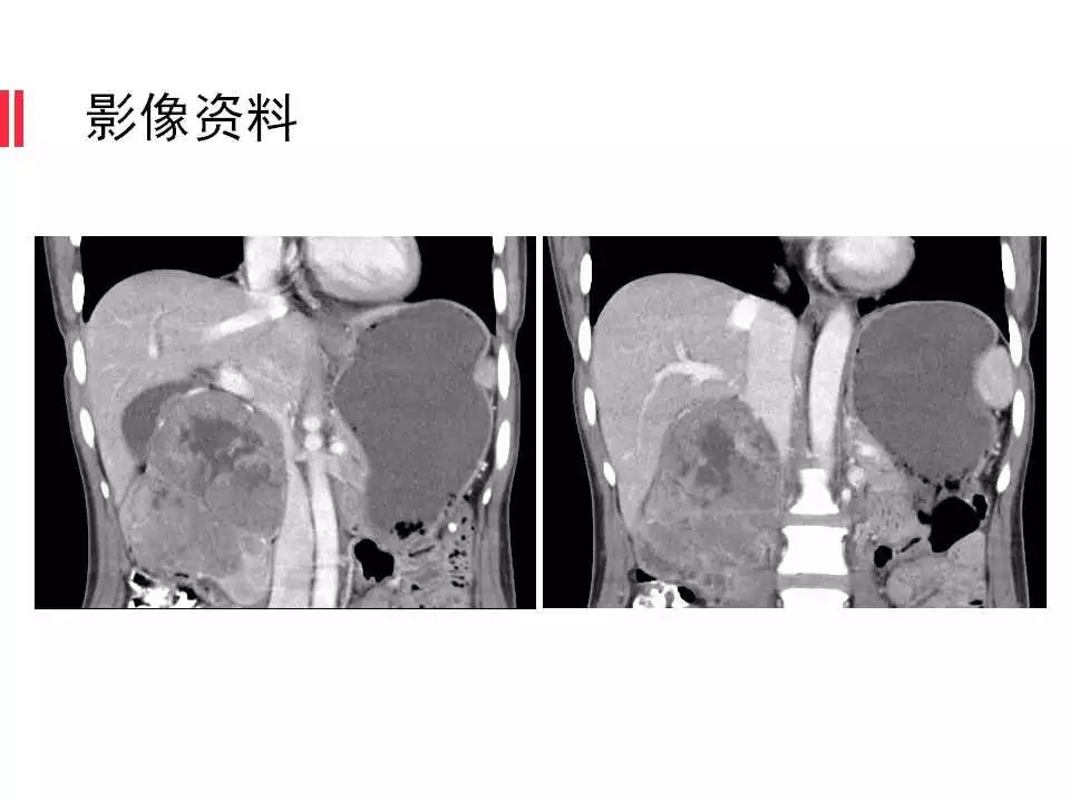 【病例】腹膜后间质瘤1例CT影像表现