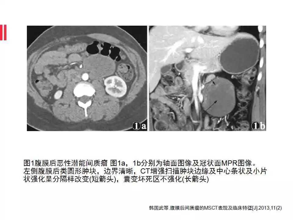 【病例】腹膜后间质瘤1例CT影像表现
