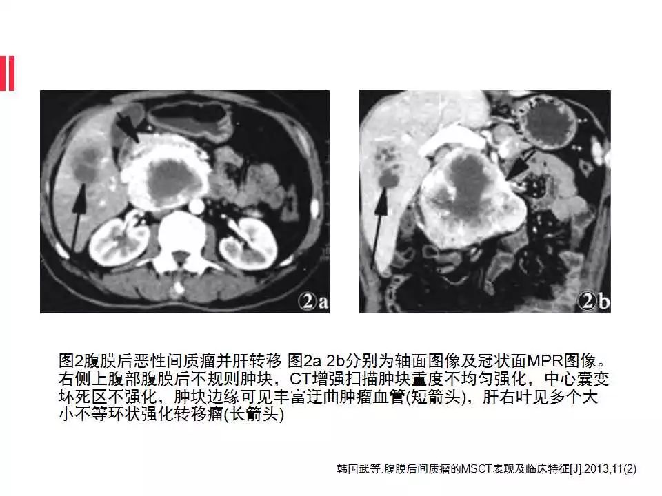 【病例】腹膜后间质瘤1例CT影像表现