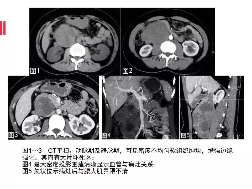 【病例】腹膜后间质瘤1例CT影像表现