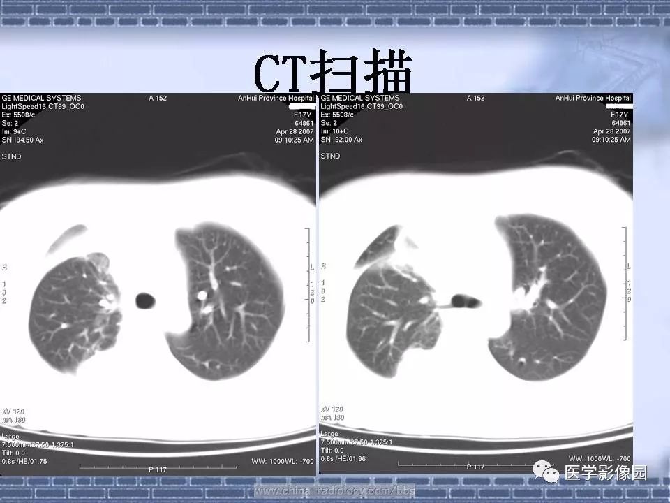 【病例】骨外尤文氏肉瘤1例CT影像表现