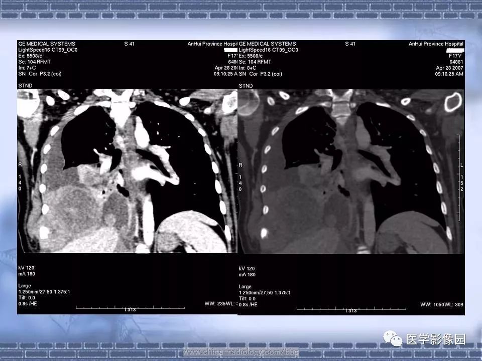 【病例】骨外尤文氏肉瘤1例CT影像表现