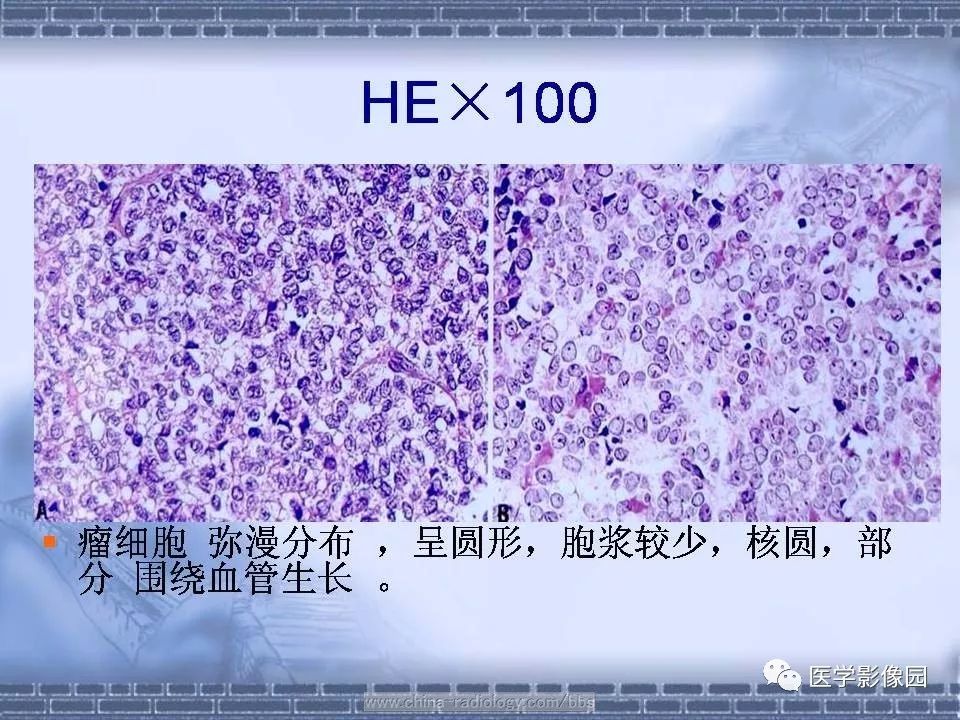 【病例】骨外尤文氏肉瘤1例CT影像表现