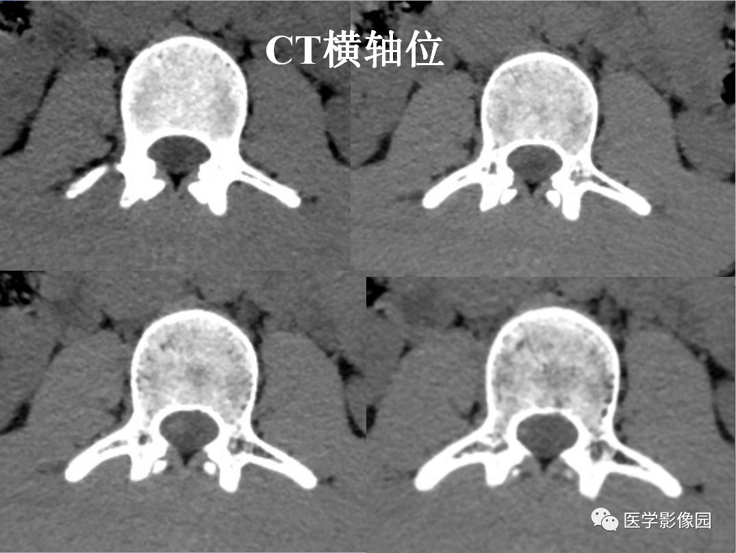 【病例】椎管内表皮样囊肿1例CT及MR