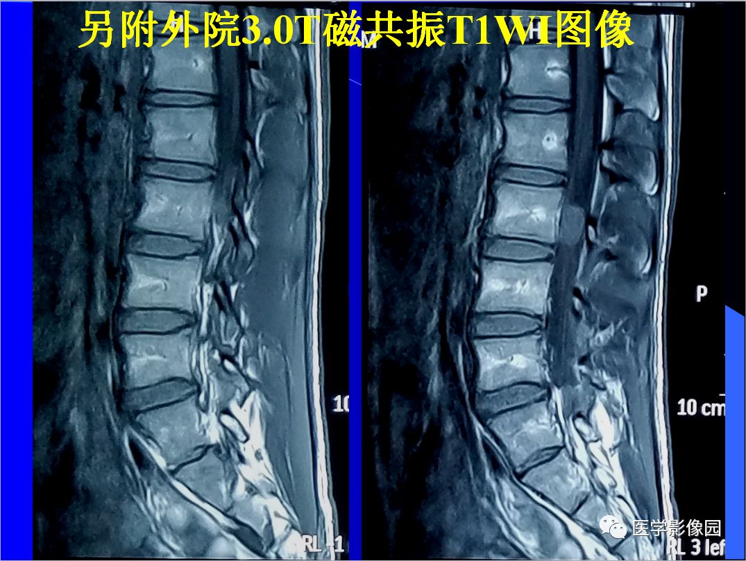 【病例】椎管内表皮样囊肿1例CT及MR