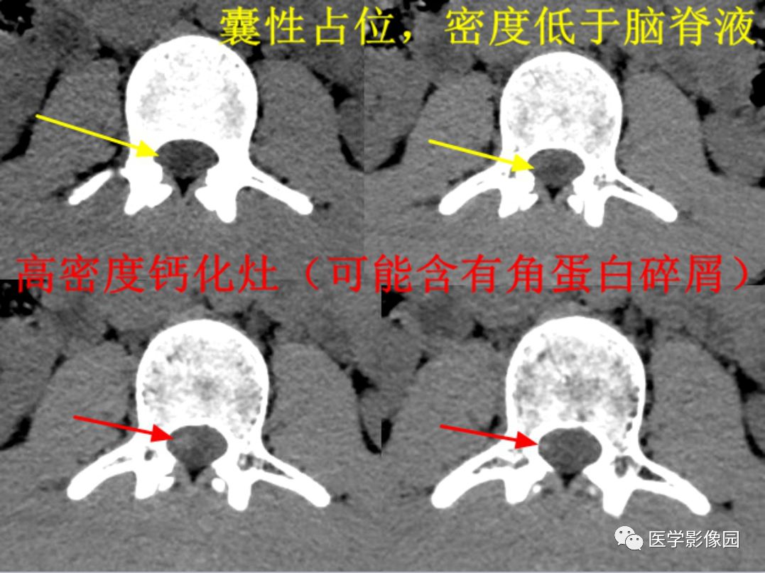 【病例】椎管内表皮样囊肿1例CT及MR