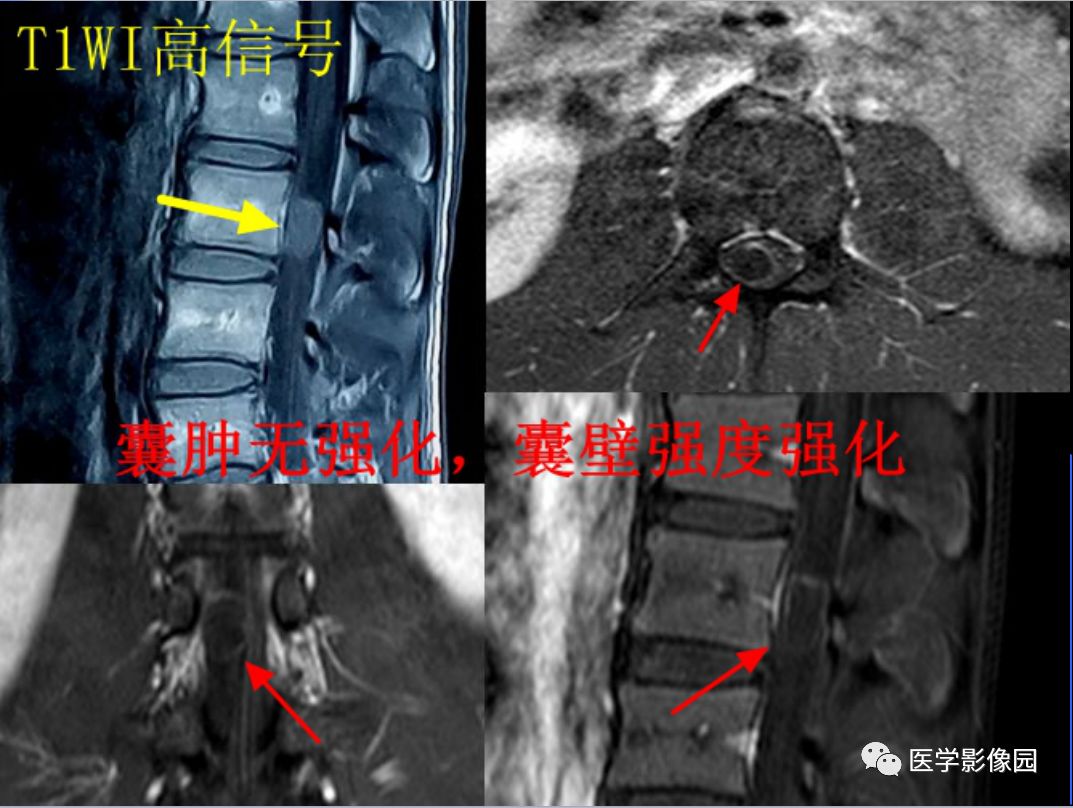 【病例】椎管内表皮样囊肿1例CT及MR