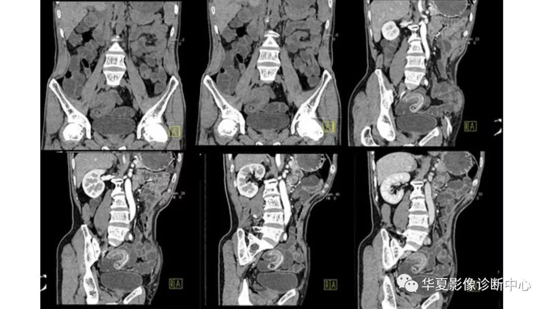 【病例】回肠异位胰腺1例CT影像表现