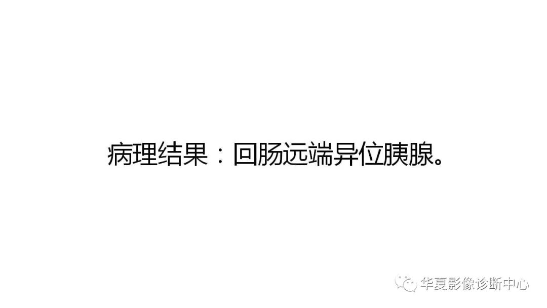 【病例】回肠异位胰腺1例CT影像表现