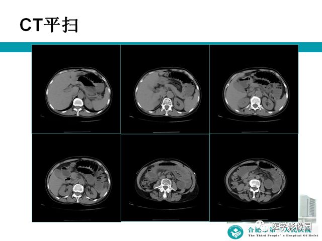 【病例】小肠系膜间质瘤1例CT 【病例】小肠系膜间质瘤1例CT