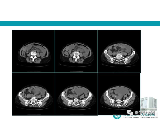 【病例】小肠系膜间质瘤1例CT 【病例】小肠系膜间质瘤1例CT