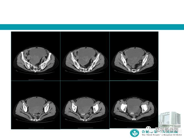 【病例】小肠系膜间质瘤1例CT 【病例】小肠系膜间质瘤1例CT