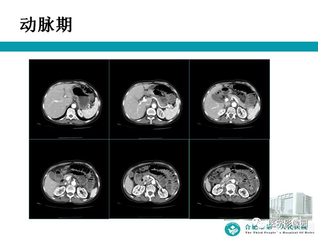 【病例】小肠系膜间质瘤1例CT 【病例】小肠系膜间质瘤1例CT