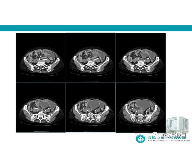 【病例】小肠系膜间质瘤1例CT 【病例】小肠系膜间质瘤1例CT