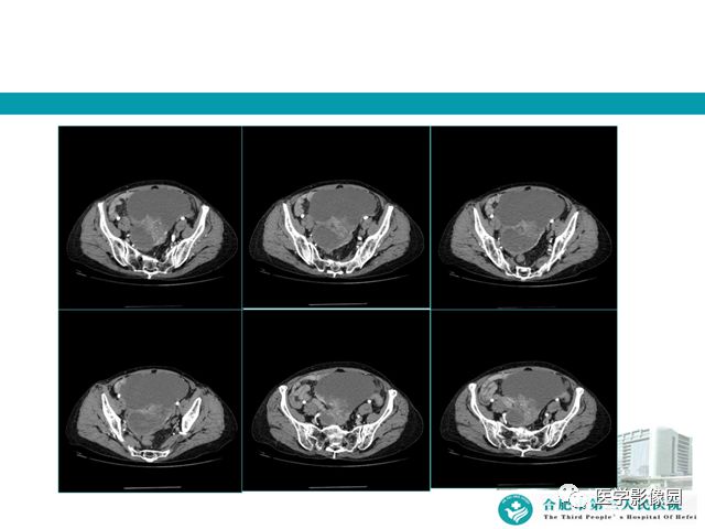 【病例】小肠系膜间质瘤1例CT 【病例】小肠系膜间质瘤1例CT