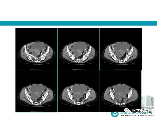 【病例】小肠系膜间质瘤1例CT 【病例】小肠系膜间质瘤1例CT