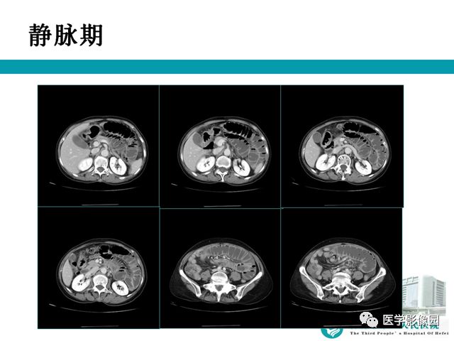 【病例】小肠系膜间质瘤1例CT 【病例】小肠系膜间质瘤1例CT