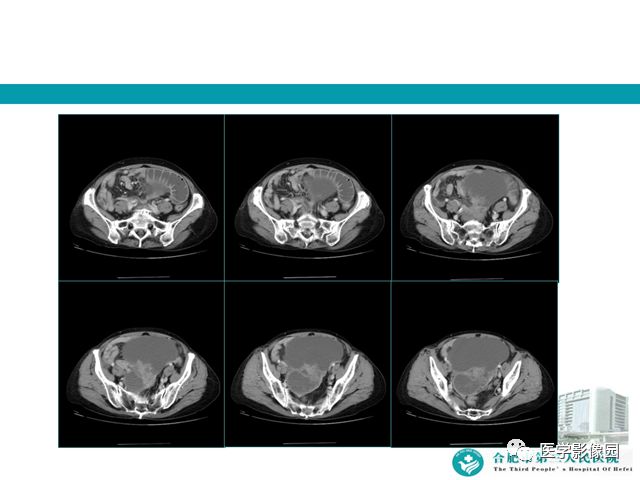 【病例】小肠系膜间质瘤1例CT 【病例】小肠系膜间质瘤1例CT