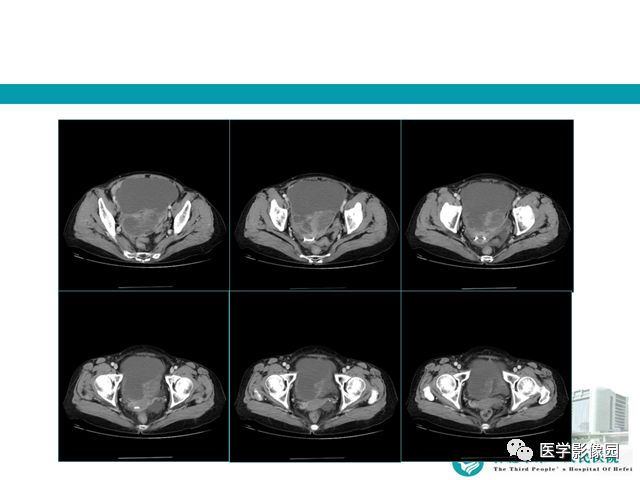 【病例】小肠系膜间质瘤1例CT 【病例】小肠系膜间质瘤1例CT