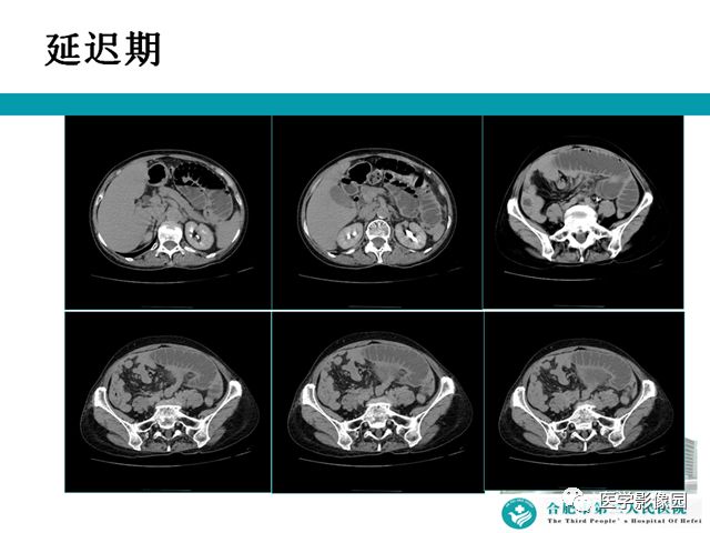 【病例】小肠系膜间质瘤1例CT 【病例】小肠系膜间质瘤1例CT