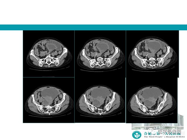 【病例】小肠系膜间质瘤1例CT 【病例】小肠系膜间质瘤1例CT