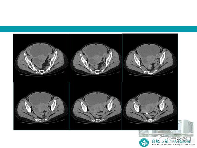 【病例】小肠系膜间质瘤1例CT 【病例】小肠系膜间质瘤1例CT