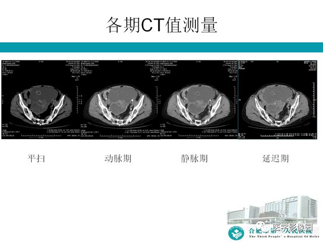 【病例】小肠系膜间质瘤1例CT 【病例】小肠系膜间质瘤1例CT