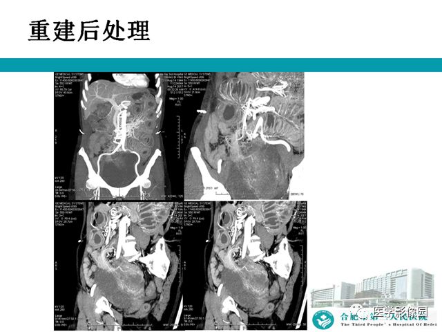 【病例】小肠系膜间质瘤1例CT 【病例】小肠系膜间质瘤1例CT