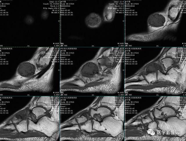 【病例】右足背腱鞘巨细胞瘤1例MR影像表现 【病例】右足背腱鞘巨细胞瘤1例MR影像表现