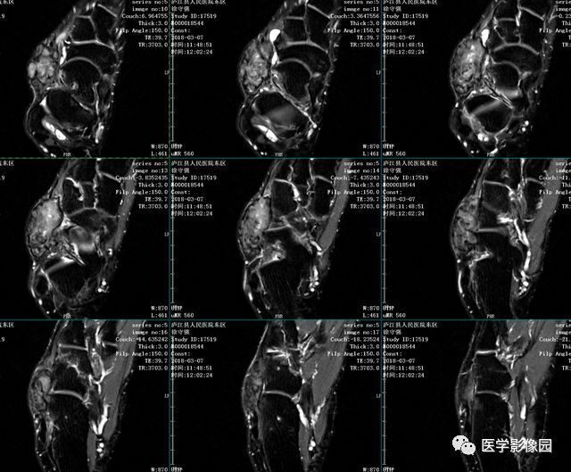 【病例】右足背腱鞘巨细胞瘤1例MR影像表现 【病例】右足背腱鞘巨细胞瘤1例MR影像表现