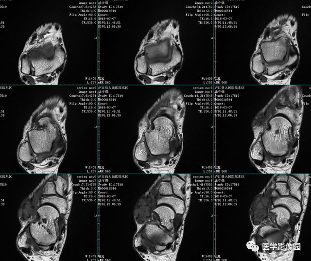 【病例】右足背腱鞘巨细胞瘤1例MR影像表现 【病例】右足背腱鞘巨细胞瘤1例MR影像表现