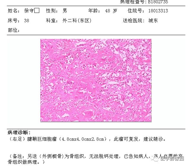 【病例】右足背腱鞘巨细胞瘤1例MR影像表现 【病例】右足背腱鞘巨细胞瘤1例MR影像表现