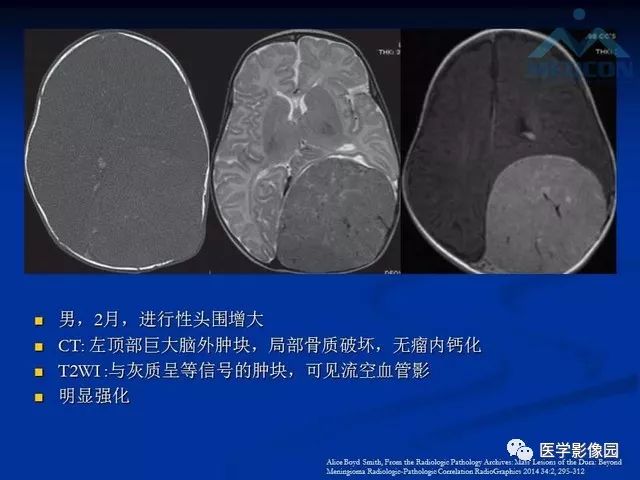 【PPT】脑膜瘤以外的硬脑膜肿块：影像学表现与鉴别诊断