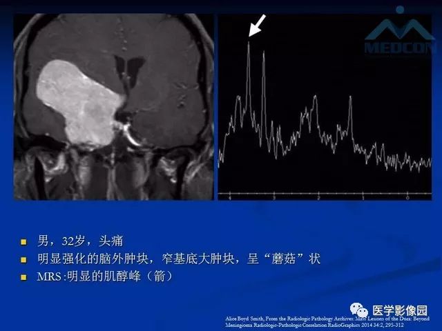 【PPT】脑膜瘤以外的硬脑膜肿块：影像学表现与鉴别诊断