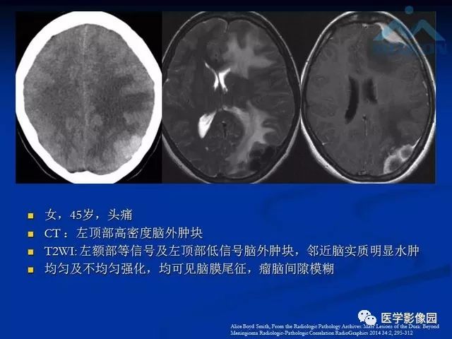 【PPT】脑膜瘤以外的硬脑膜肿块：影像学表现与鉴别诊断