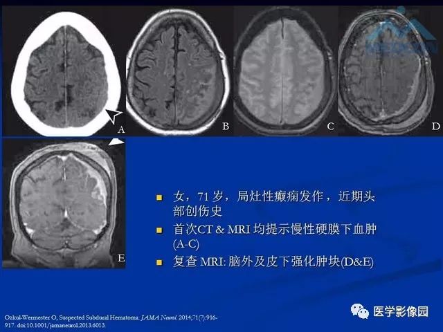 【PPT】脑膜瘤以外的硬脑膜肿块：影像学表现与鉴别诊断