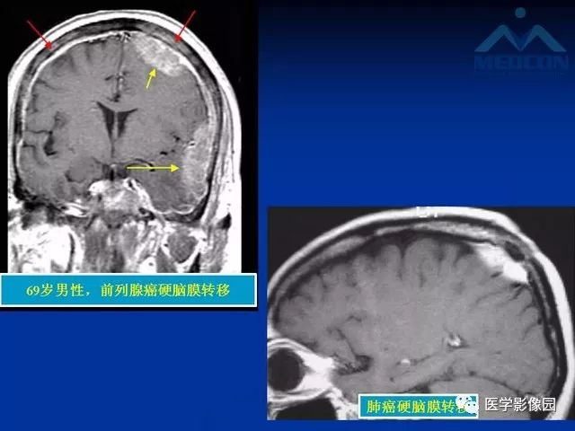 【PPT】脑膜瘤以外的硬脑膜肿块：影像学表现与鉴别诊断