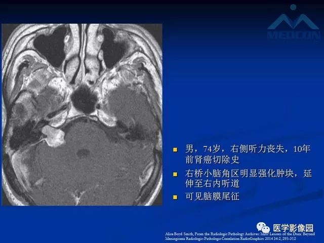 【PPT】脑膜瘤以外的硬脑膜肿块：影像学表现与鉴别诊断