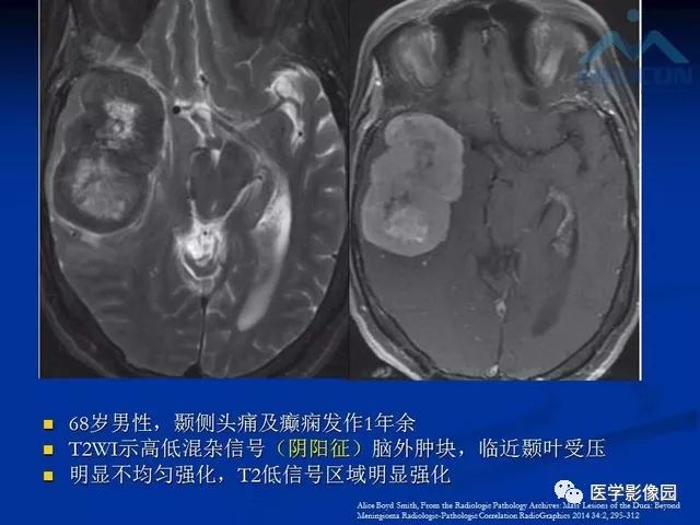 【PPT】脑膜瘤以外的硬脑膜肿块：影像学表现与鉴别诊断