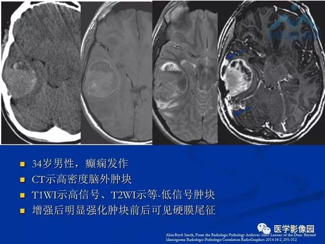 【PPT】脑膜瘤以外的硬脑膜肿块：影像学表现与鉴别诊断