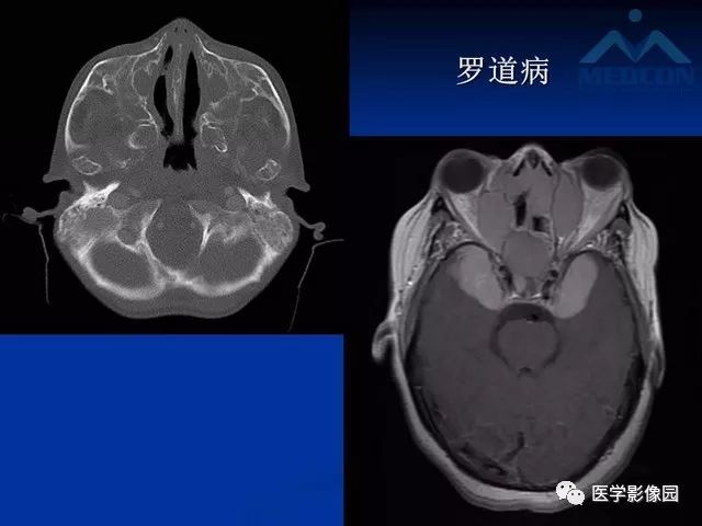 【PPT】脑膜瘤以外的硬脑膜肿块：影像学表现与鉴别诊断